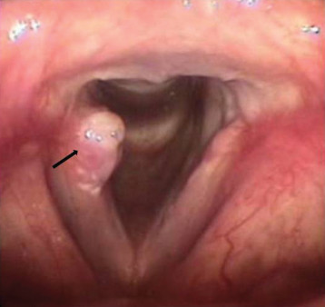 역류성 식도염 증상
