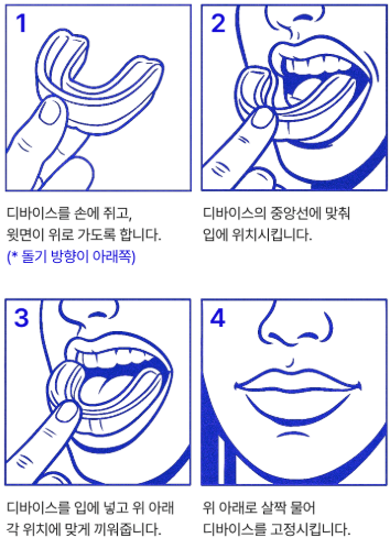 덴탈스 인비저,자가치아교정기,덴탈스 후기,가정용 치아교정기,덧니 교정,돌출입 치아교정기,braces,치아관리템