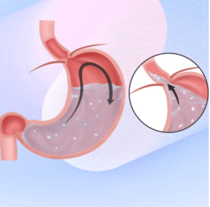 역류성 식도염을 자세히 설명한 그림