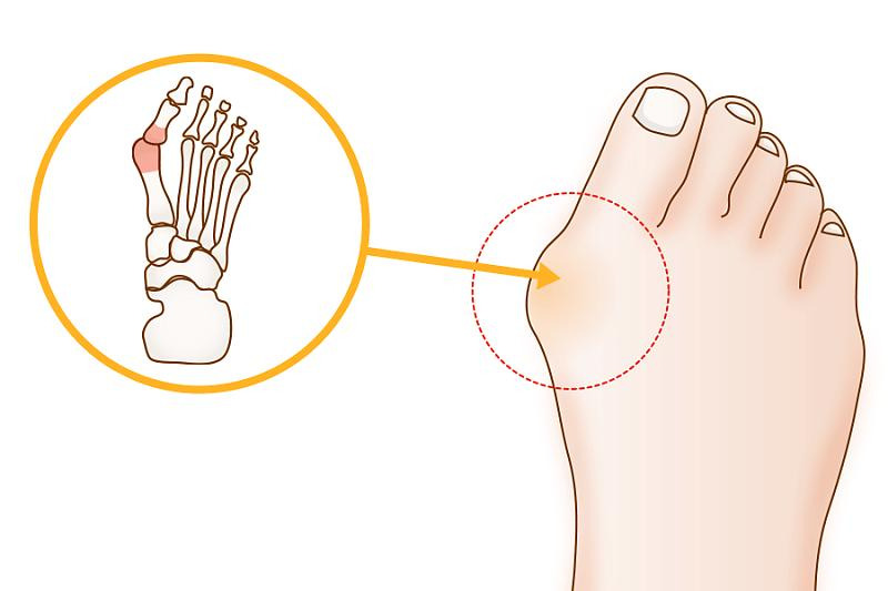 엄지발가락 통증의 원인 그리고 무지외반증이란?
