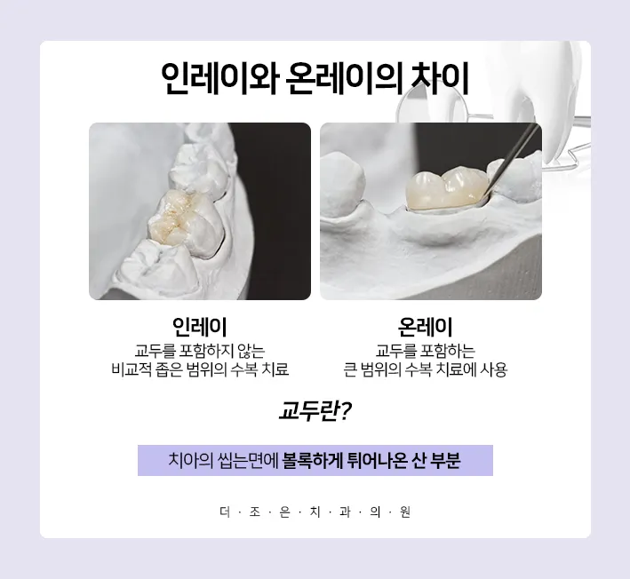 인레이 온레이의 차이와 치료 방법_7