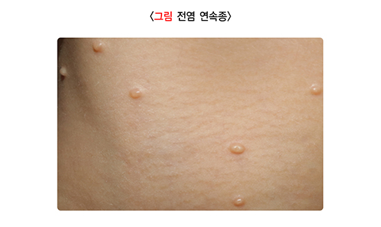 물사마귀