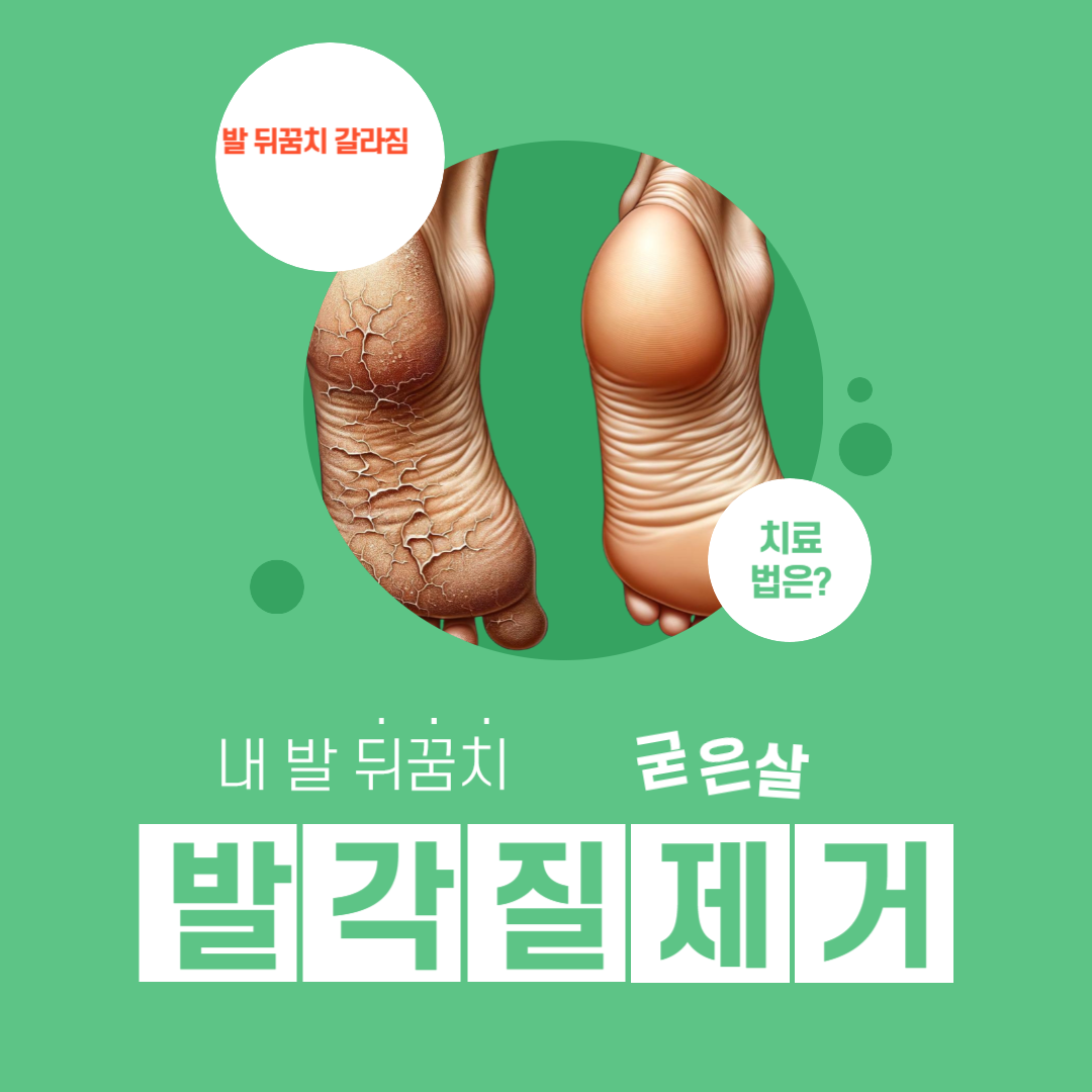 발 뒤꿈치 갈라짐 치료법