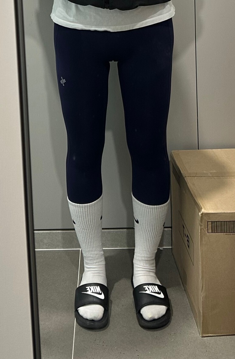 허벅지 지방흡입 후기