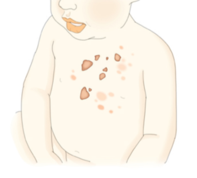 농가진의 예방법