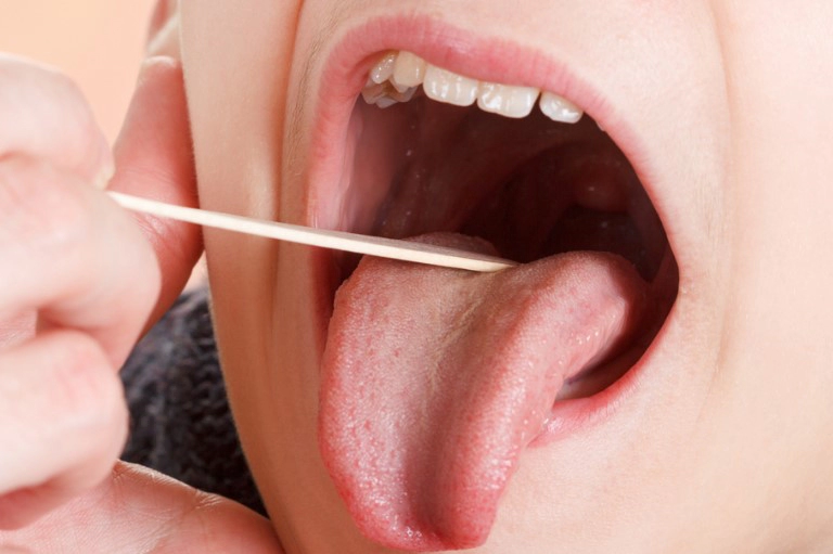 편도결석 자연치유 방법