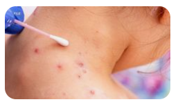 어린이-홍역-증상