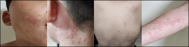 두드러기 증상 이미지