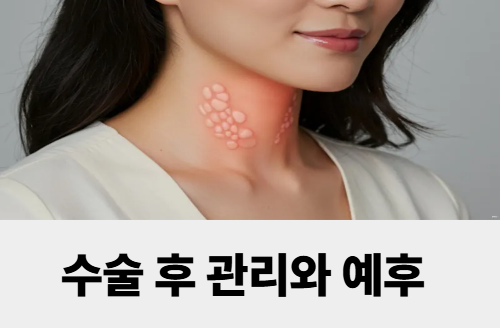 갑상선암