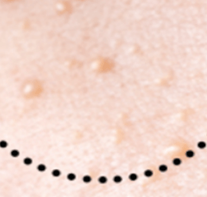 눈밑에 하얀 좁쌀