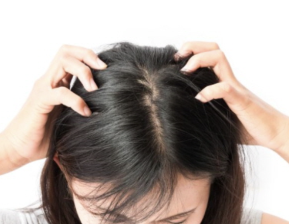 두피 가려움증 원인, 샴푸 해결 후기 섬네일