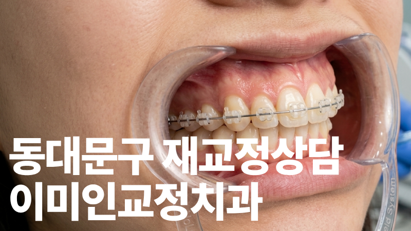 동대문구치아재교정, 재교정상담, 치아교정전문,이미인교정치과