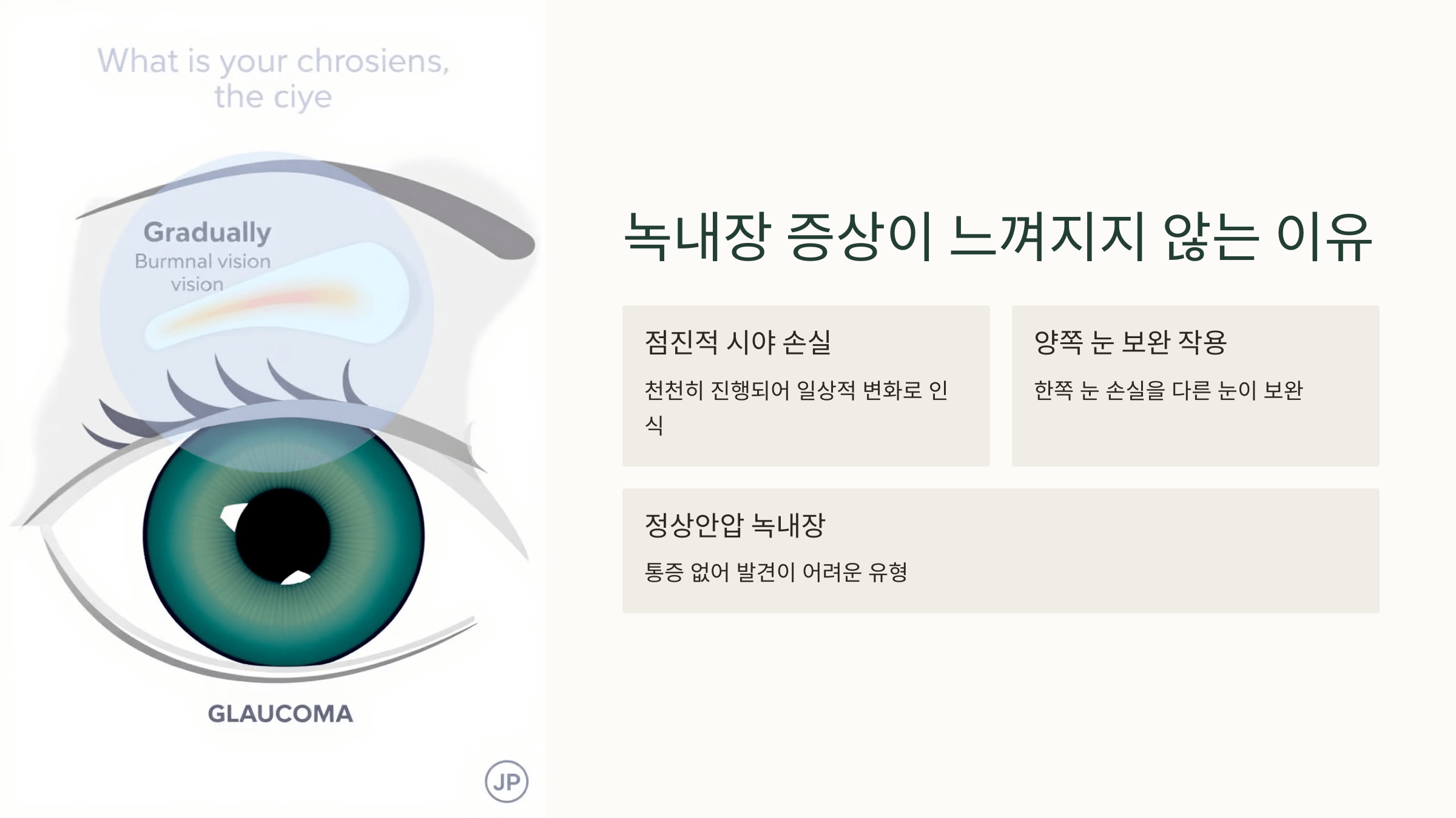 녹내장과 관련된 사진입니다.