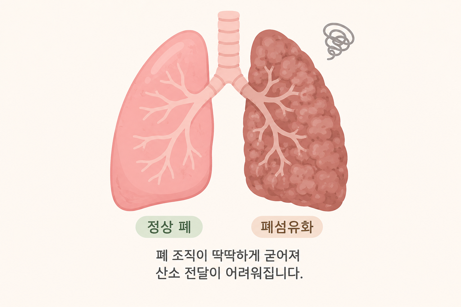 폐섬유화
