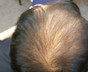 쏘팔메토의 효능