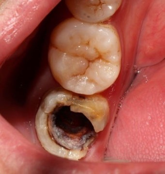 썩인-이빨이-구멍이-나있는-심각한-모습