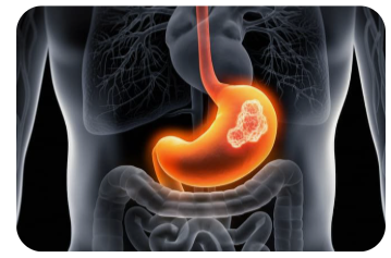 위궤양-위암-내시경