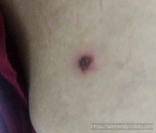 쥐젖 냉동치료 후 관리 부족으로 상처