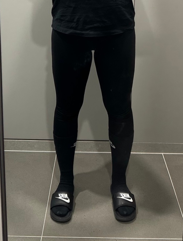 허벅지 지방흡입 후기