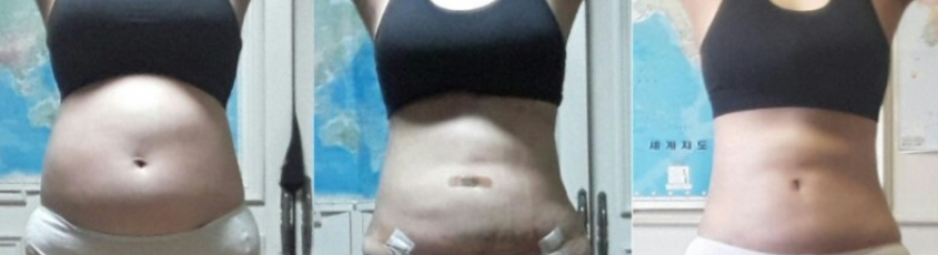 복부지방흡입 후기