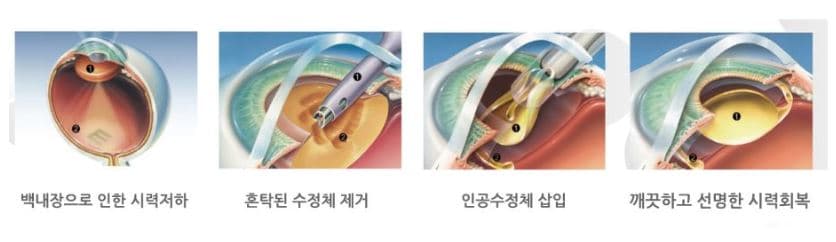 백내장수술비용