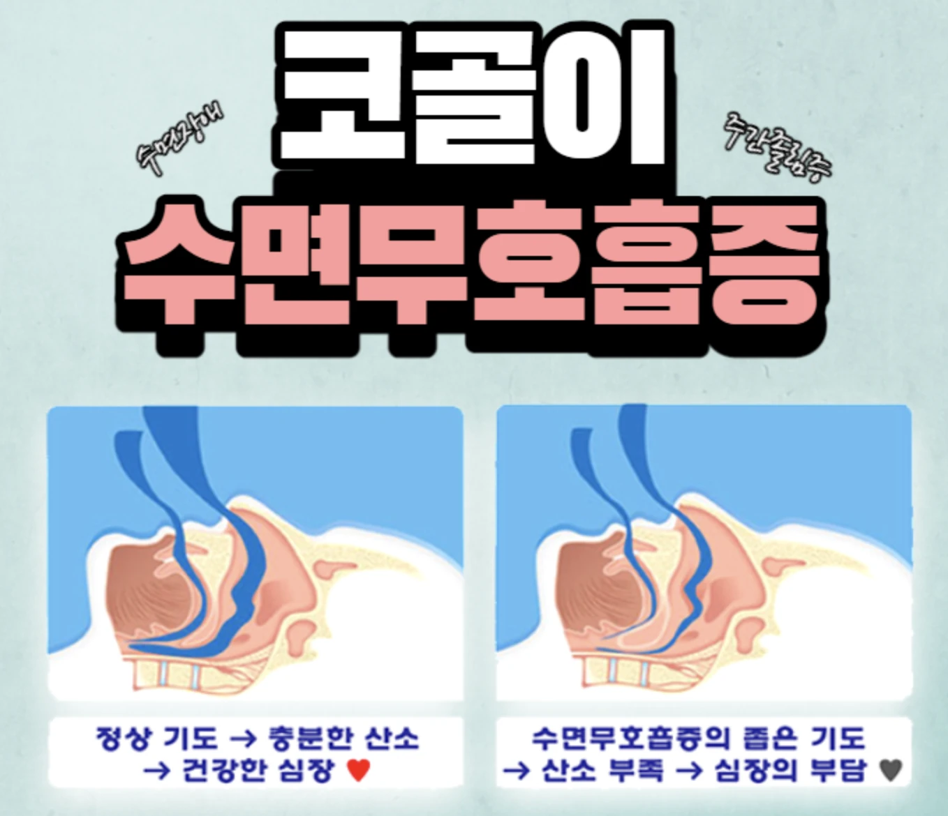 수면 무호흡증