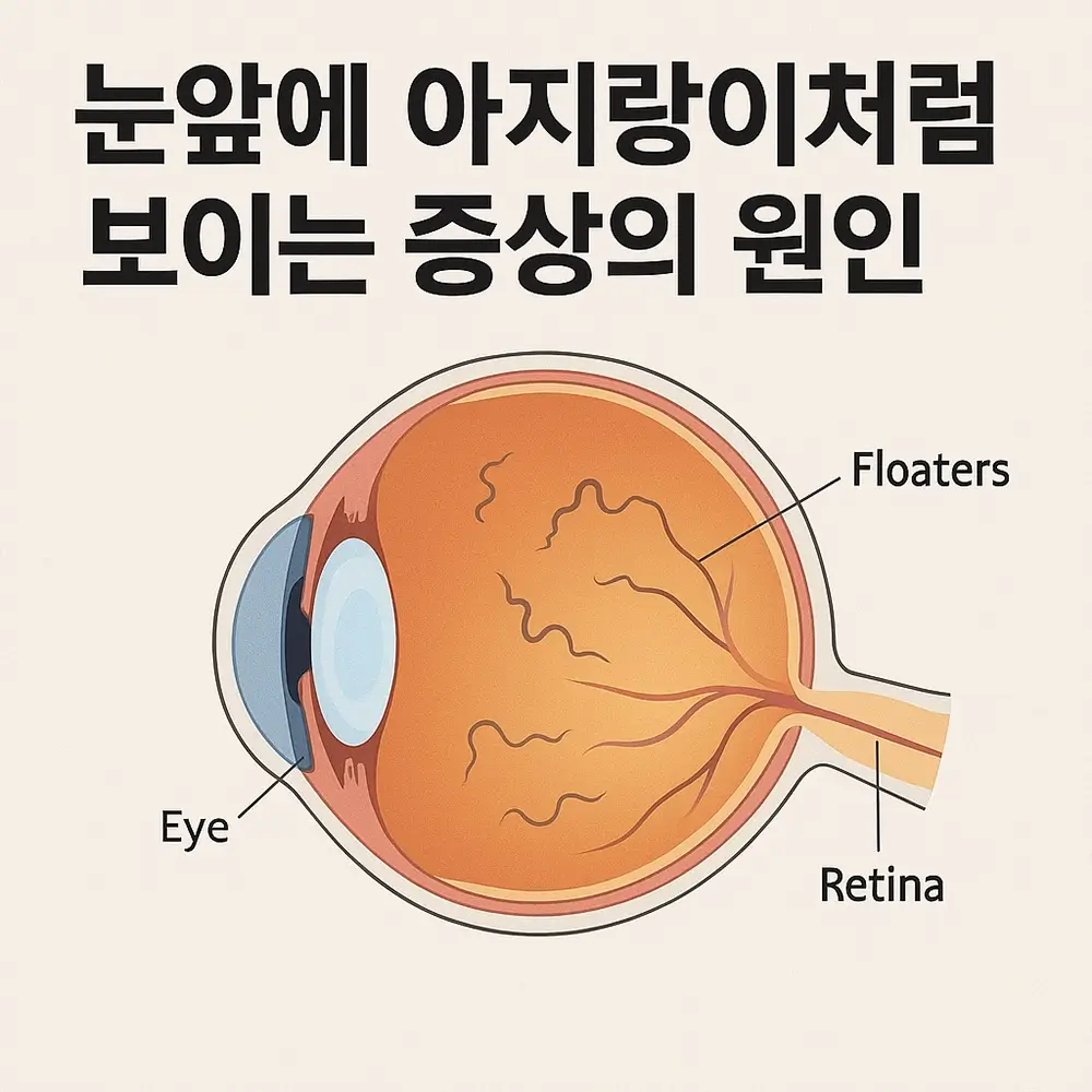 눈앞에 아지랑이 어지럼증 비문증 원인과 치료 방법