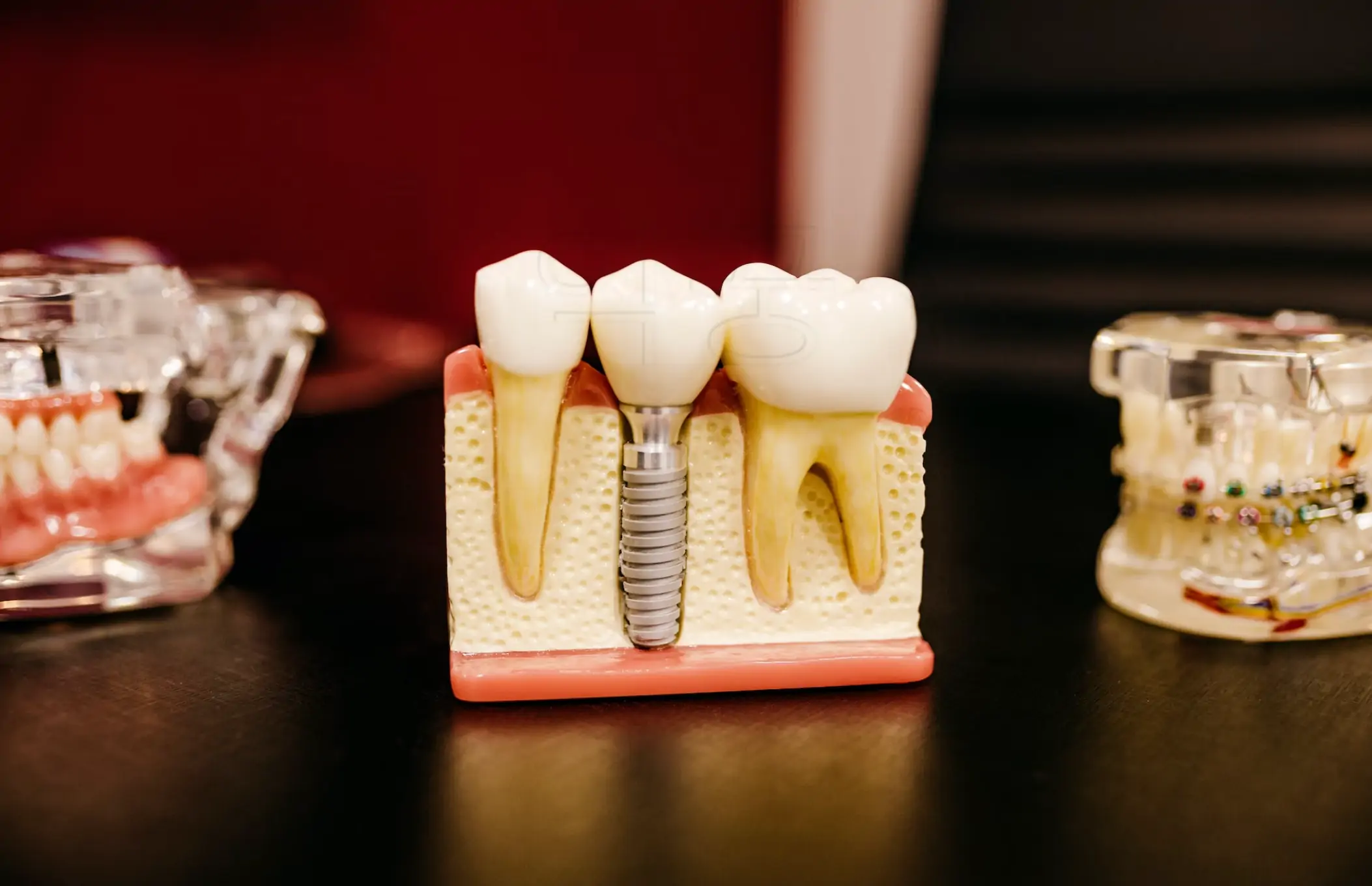 임플란트 통증 관련 사진