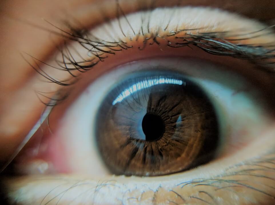 유리체 출혈된 모습