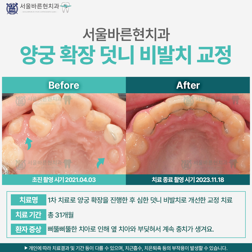 마린시티치아교정