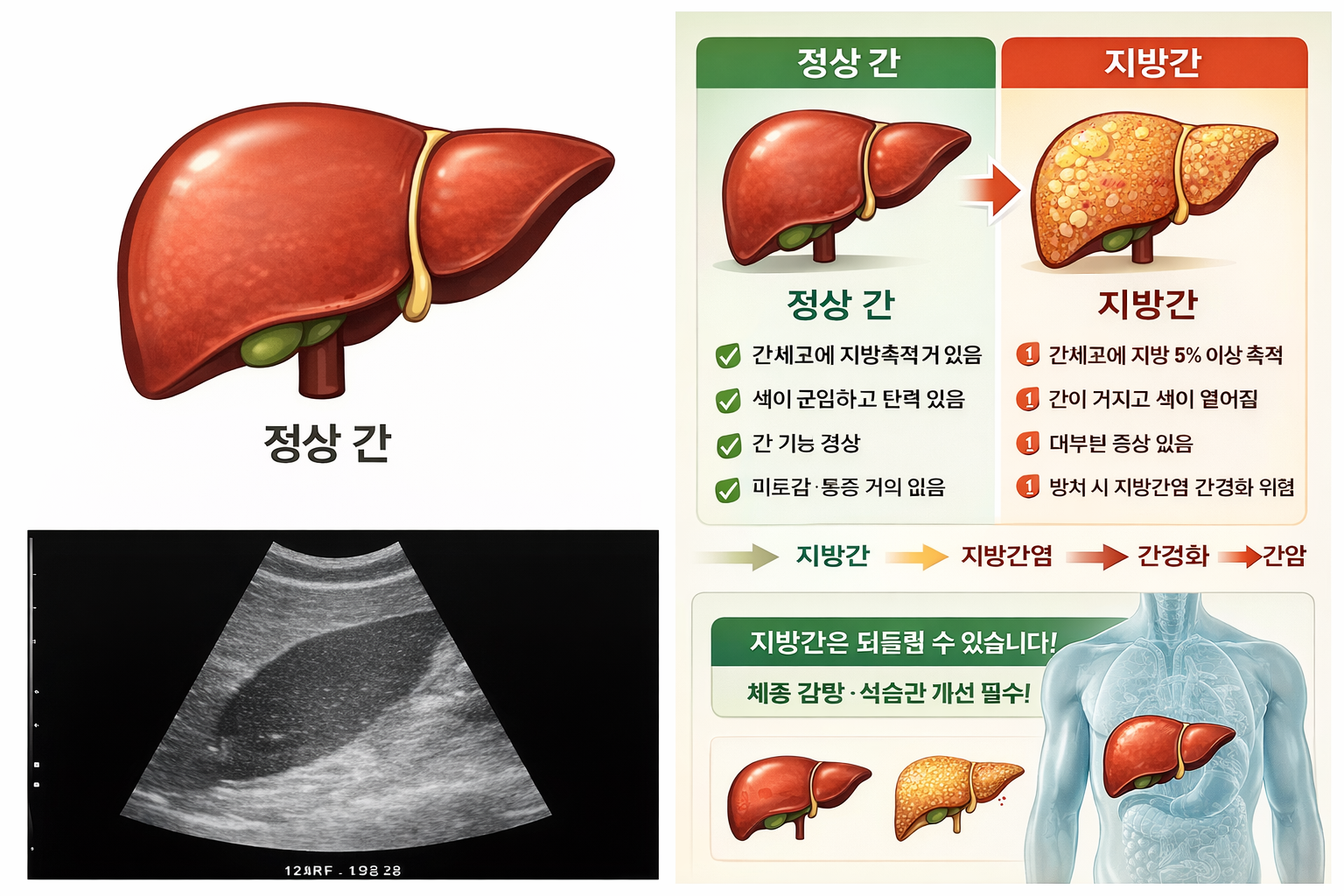 정상 간과 지방간