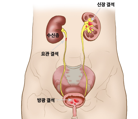 요로결석-사진