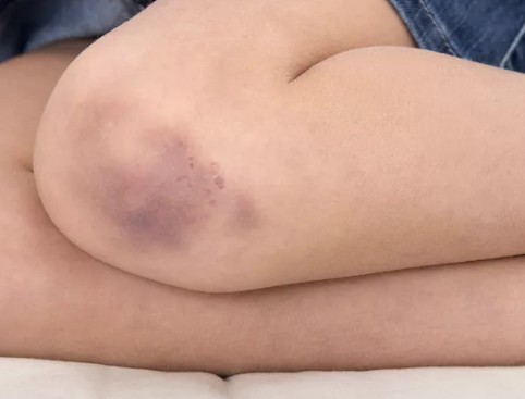 [멍 없애는 법] 종류에 따른 멍 빨리 빼는법