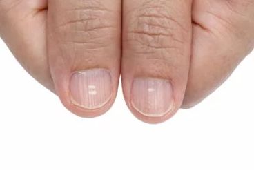 손톱 세로줄 무늬