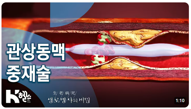 송대관 사망 심장마비 심근경색 ❘ 90%가 모르는 심근경색 전조 증상 ❘ 예방