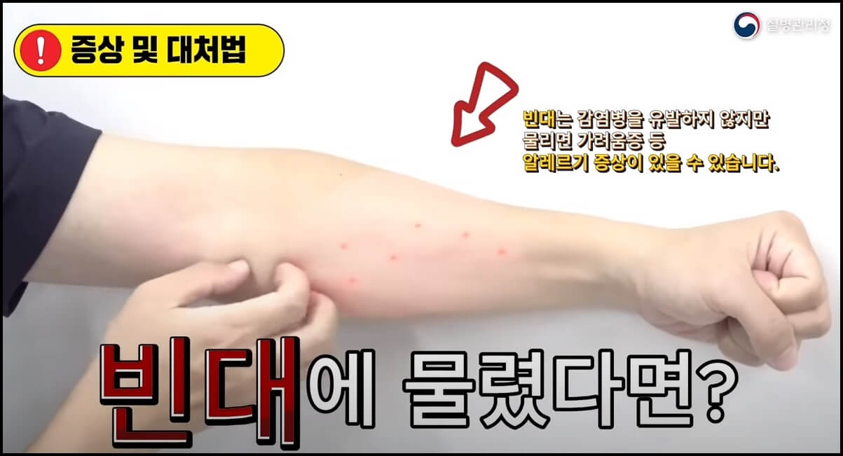 빈대 물렸을 때 가려움증