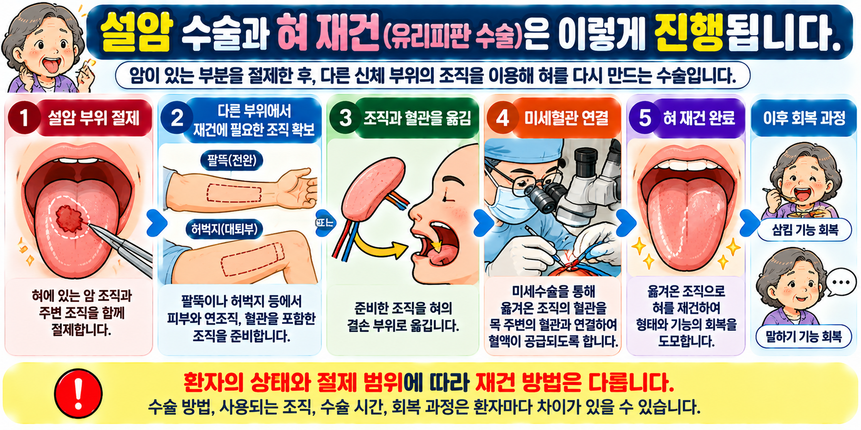 설암 수술 후 팔뚝이나 허벅지 조직을 이용한 혀 유리피판 재건 과정을 설명하는 인포그래픽