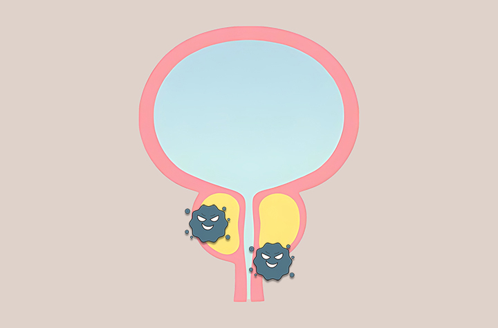 감염이-된-전립선