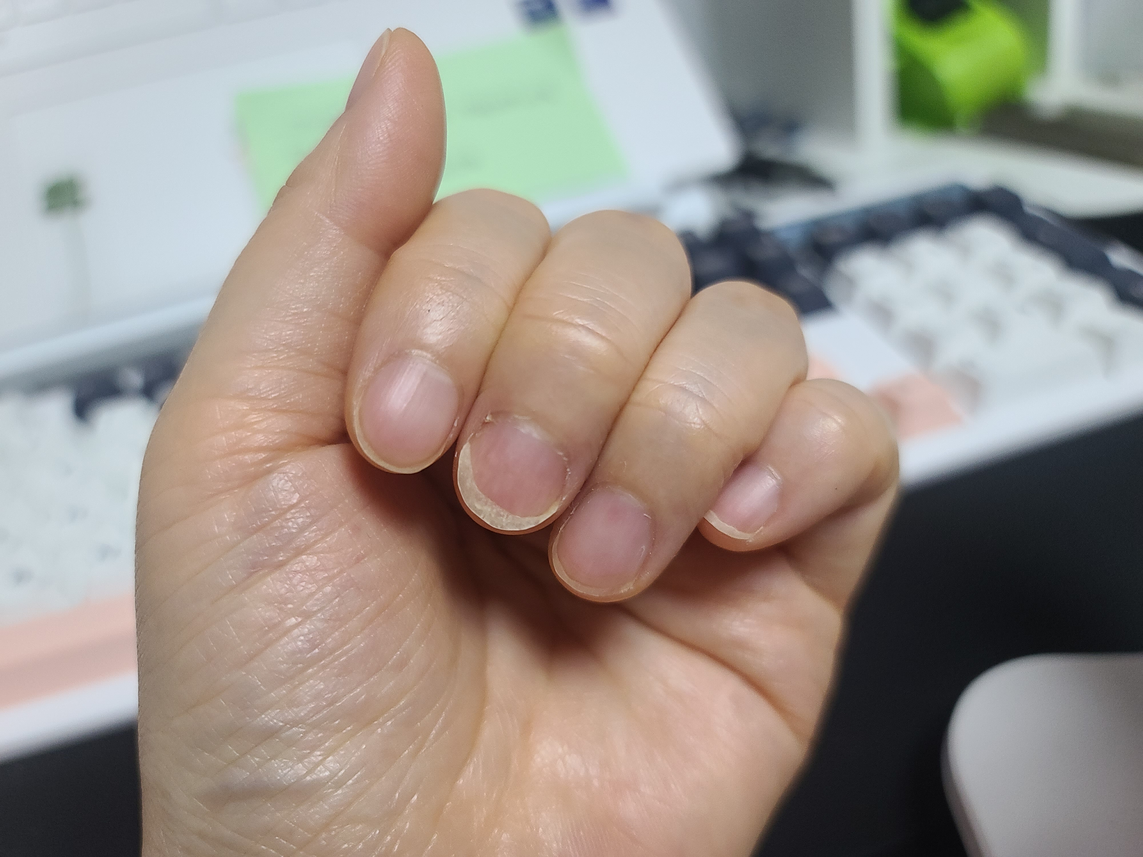 조갑박리증