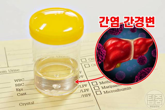 소변색깔 건강상태,투명한소변색 간염 간경변,소변색깔이 뿌옇다