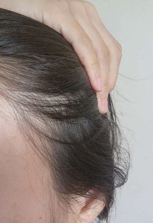 두피 가려움 해결