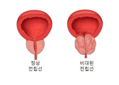 전립선비대증