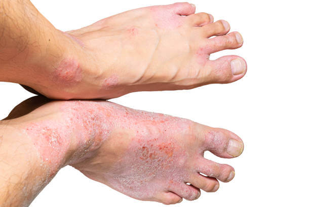 발바닥 껍질 벗겨짐 원인은?, 발바닥은 지속적인 충격을 받는 부위로 심장에서 가장 멀고 혈액순환이 잘 되지 않는 부위입니다. 일상생활 중 자주 손을 씻고 눈으로 확인하는 부분이지만, 발은 양말이나 신발을 신는 등 자주 눈여겨보지 않는 부분입니다. 그렇다면 왜 발바닥 껍질이 벗겨질까요?