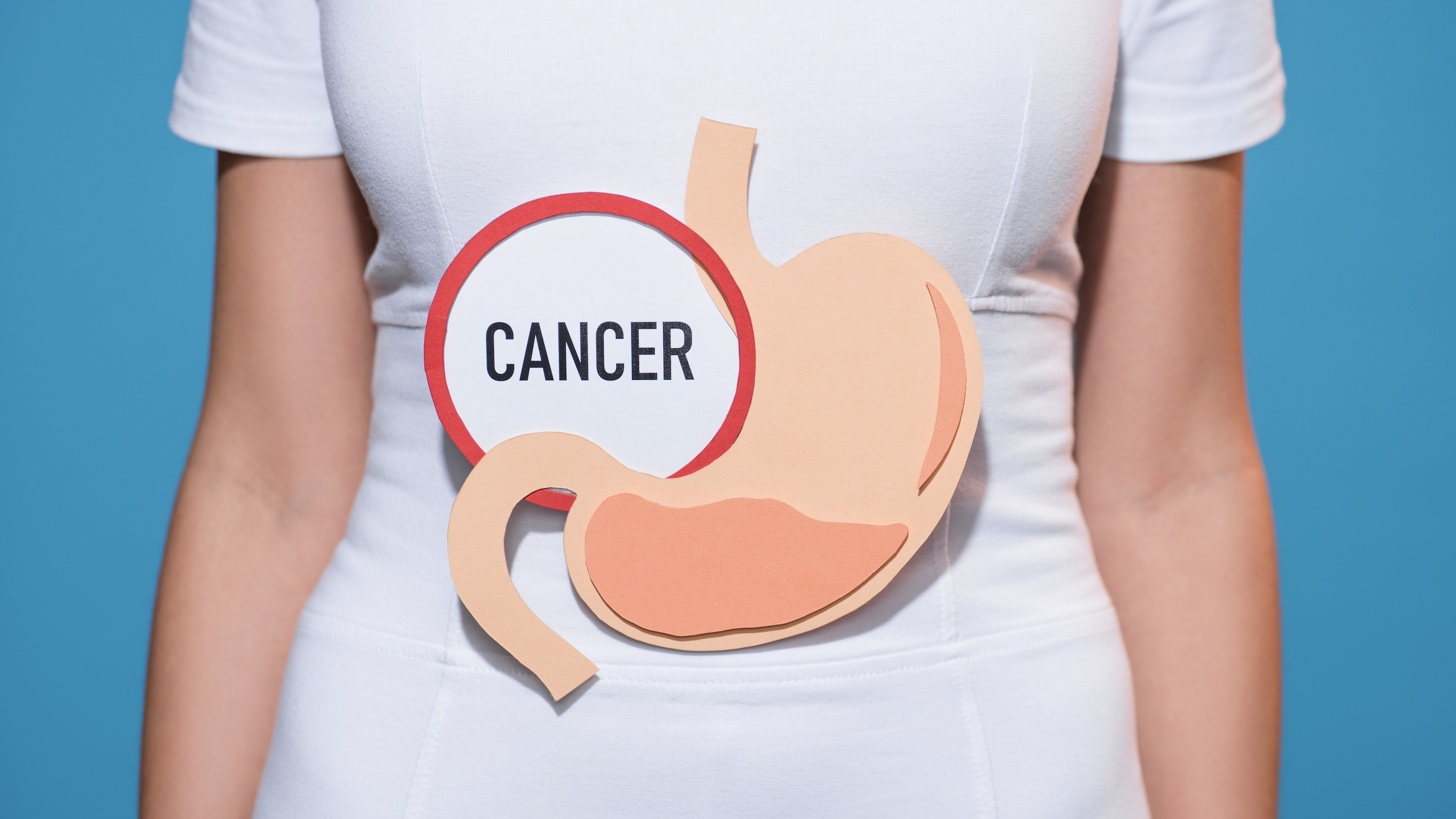 장상피화생과 위암의 연관성