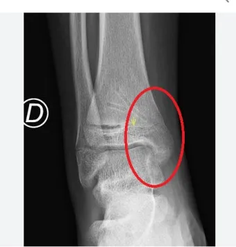 성장판 닫혀도 키 클 수 있는 방법과 성장 호르몬 시기_3