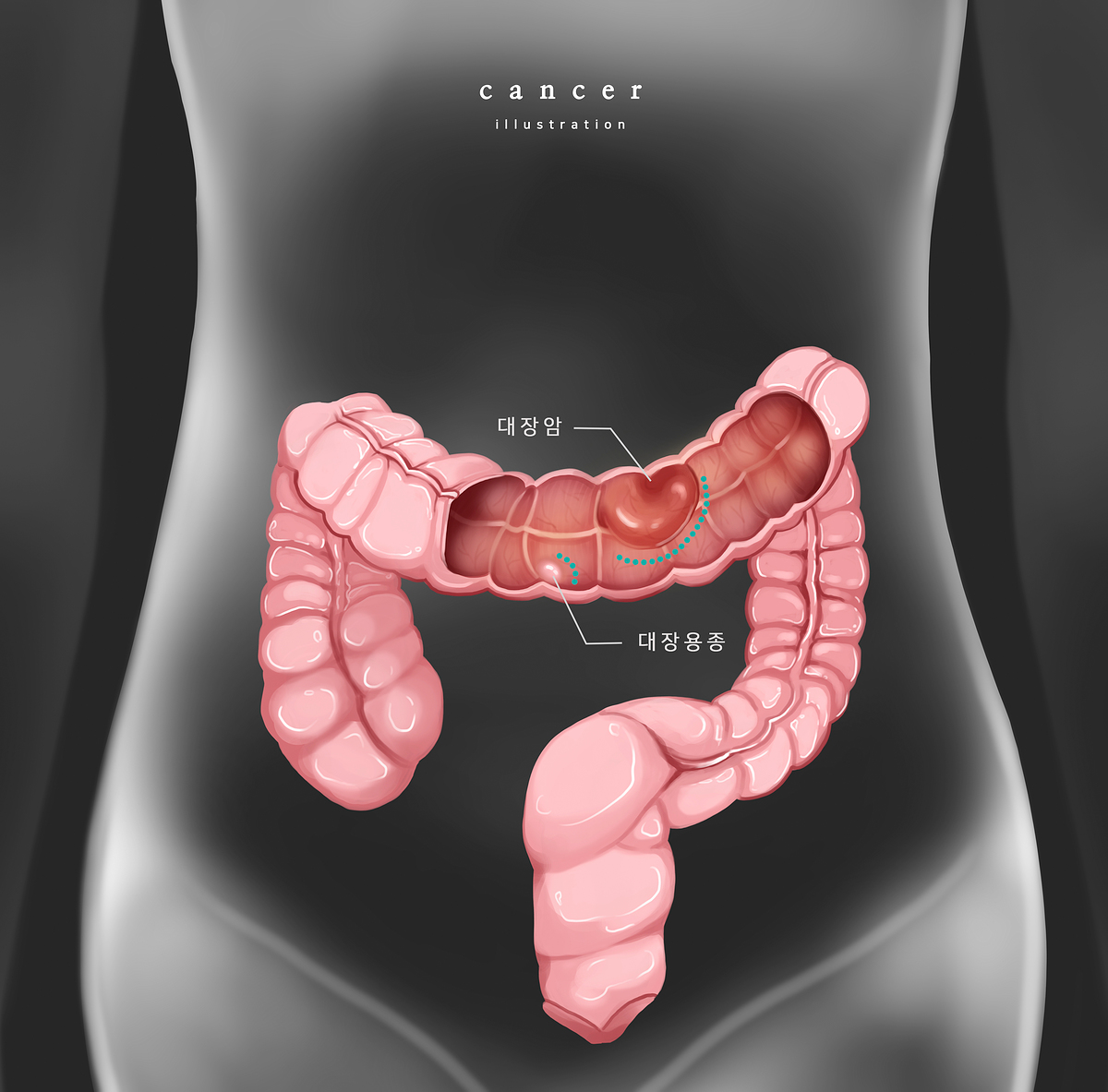 대장암 초기 증상