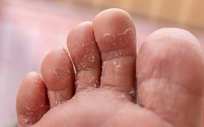 무좀 피부과 비용 정리