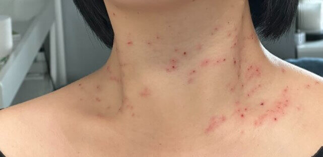 쥐젖 제거 후 상처