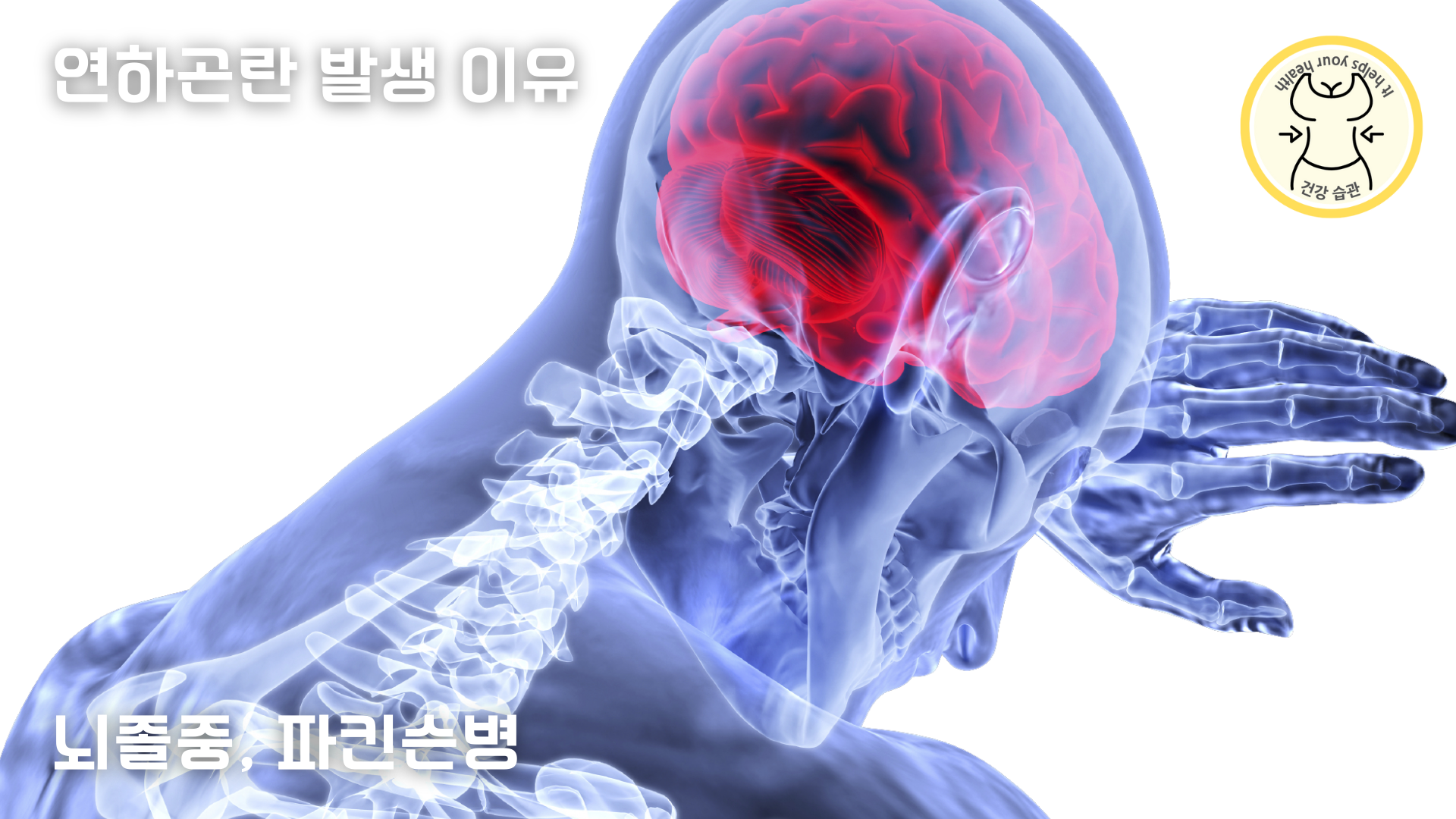 뇌졸중, 파킨슨병으로 인한 연하곤란