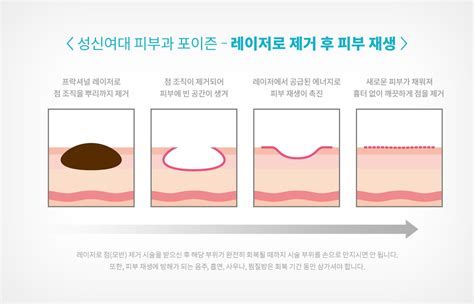 눈비립 종 제거